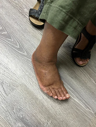 A patient's foot after receiving treatment