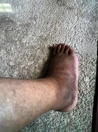 A patient's foot before receiving treatment